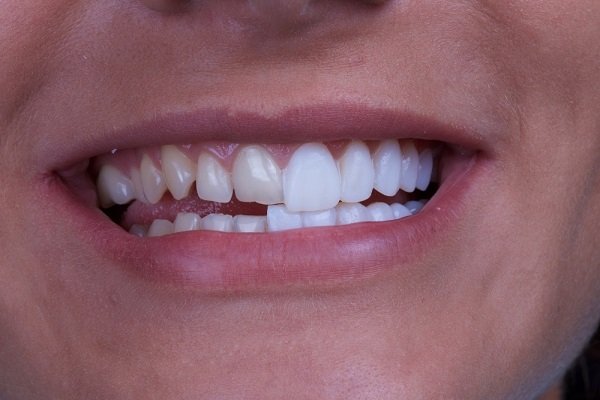 Răng sứ veneer