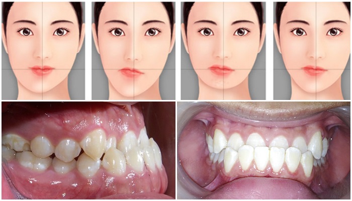những trường hợp không nên bọc răng sứ