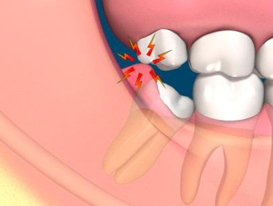 Sưng răng sau khi nhổ răng khôn