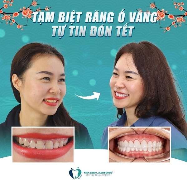 Chi phí trám răng hiện nay tại nha khoa Hanseoul đang có nhiều ưu đãi dịp Tết 2023