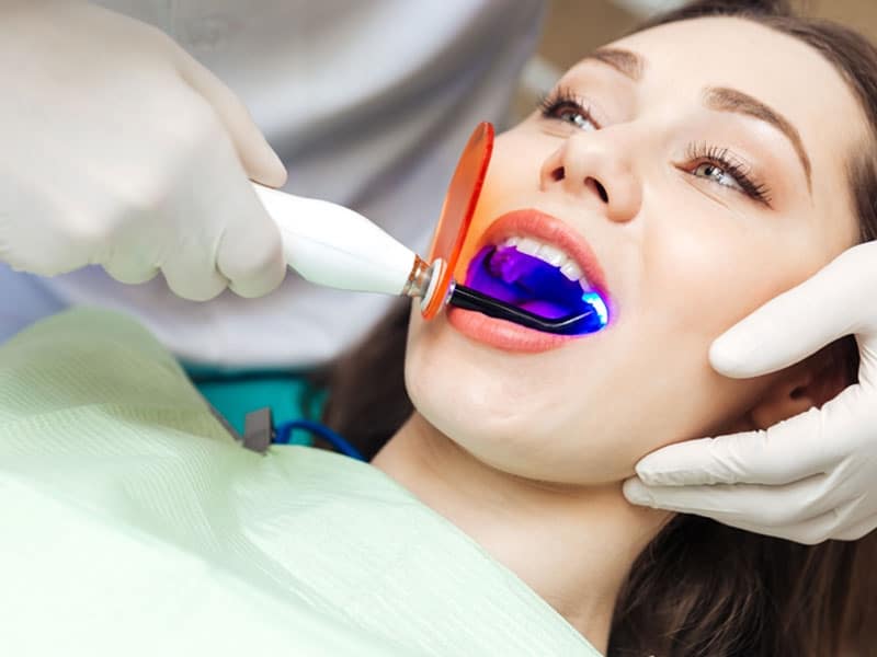 Tẩy trắng răng tại nhà