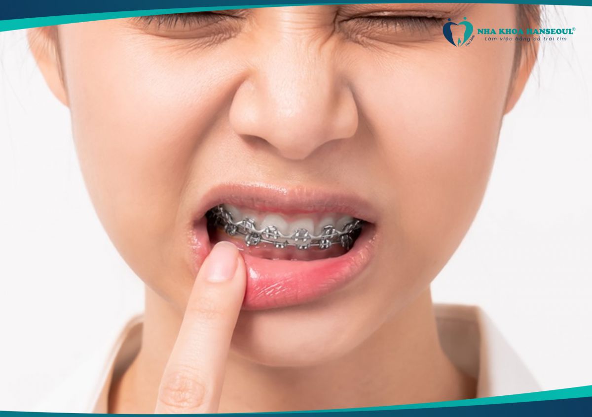 Bắt đầu niềng răng sẽ có cảm giác đau nhức 