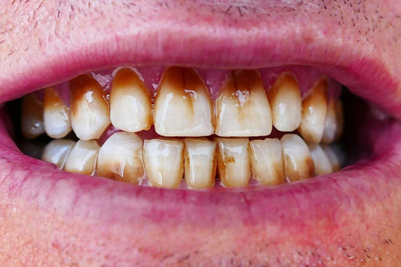 Hút thuốc lá làm xỉn răng