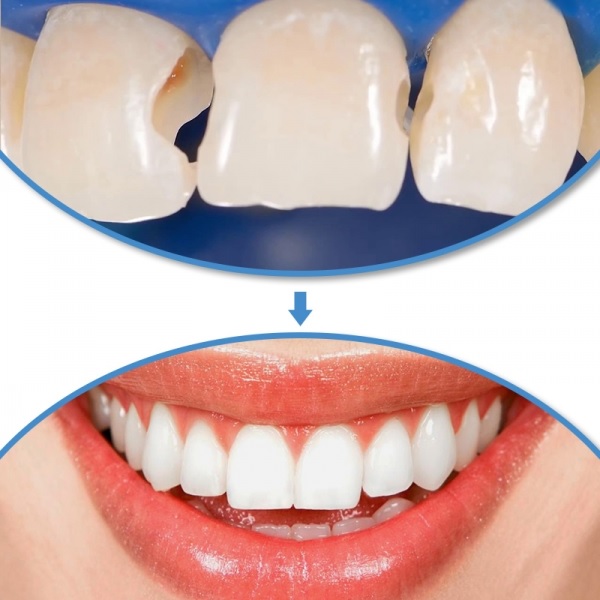Trám răng bằng composite filtek Z350XT 