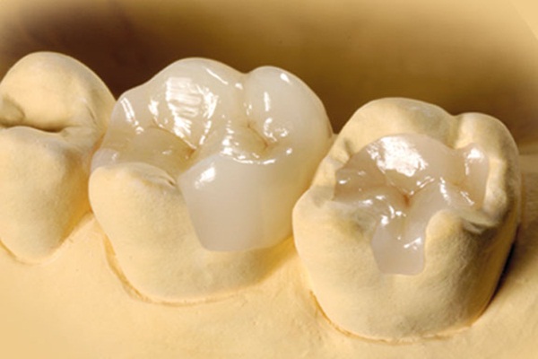 Trám răng bằng sứ