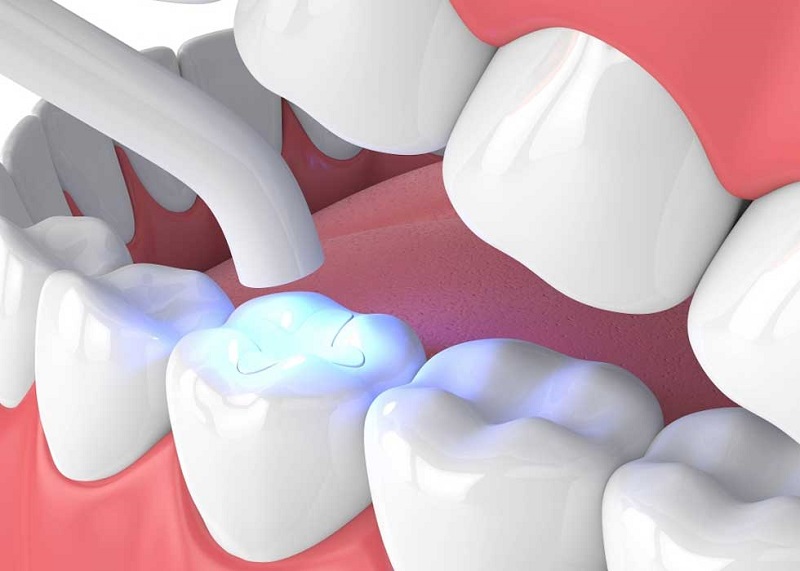 Trám răng lonomer thủy tinh
