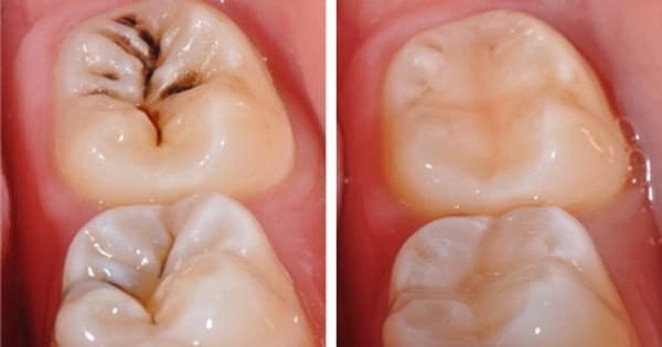 Trám răng sâu bao nhiêu tiền