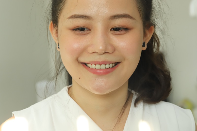 Bệnh nhân trám răng thẩm mỹ tại Hanseoul