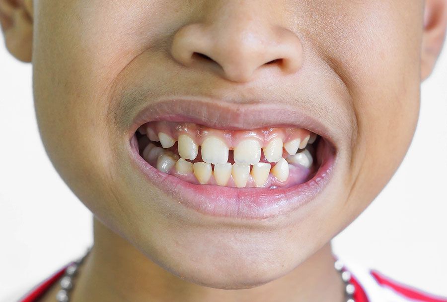 Bọc răng sứ trẻ em dưới 17 tuổi