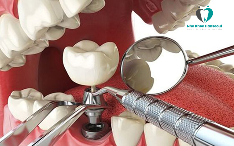 Trồng răng Implant mất bao lâu