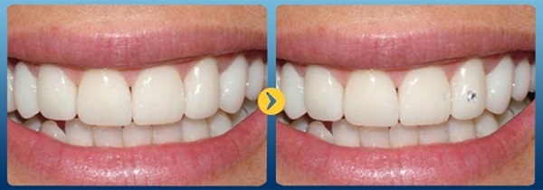 Trước sau đính đá răng