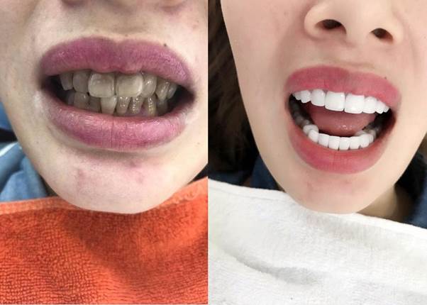 Hình ảnh trước và sau khi bọc răng sứ