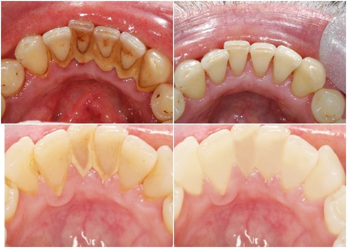Trước sau khi lấy cao răng