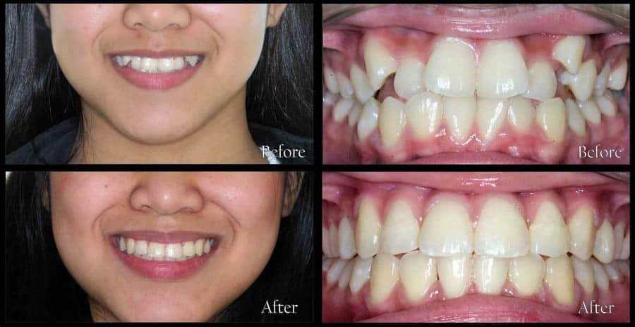 Trước và sau khi niềng răng khểnh