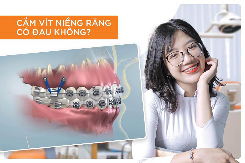 Trường hợp bắt vít niềng răng
