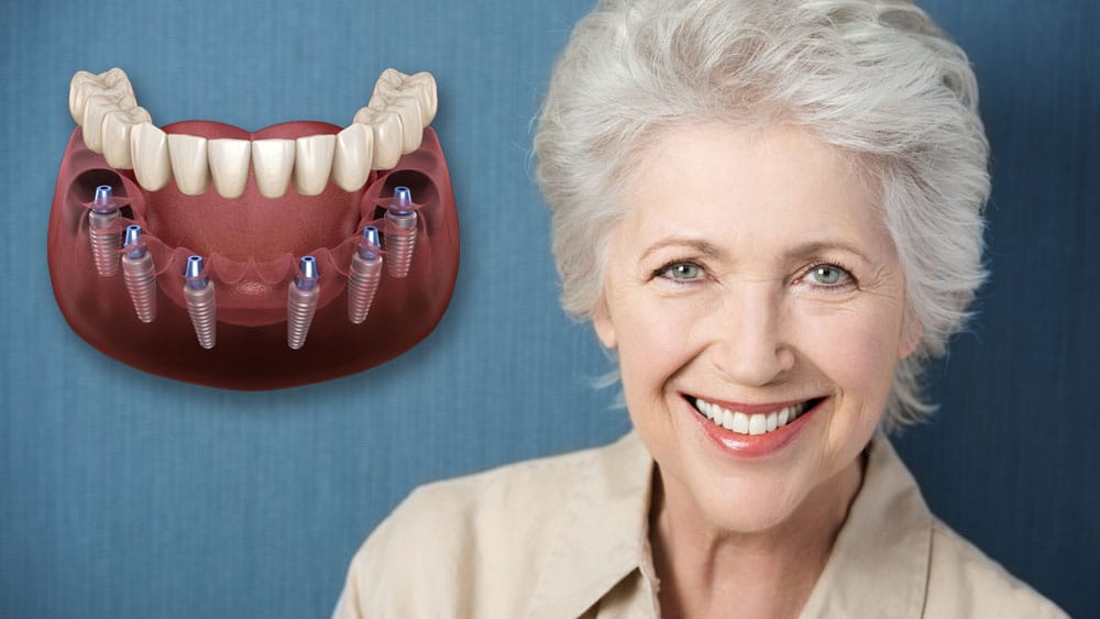 Ưu điểm của cấy ghép răng implant all on 4 và 6