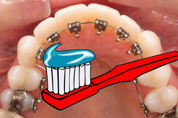 Vệ sinh niềng răng mặt trong