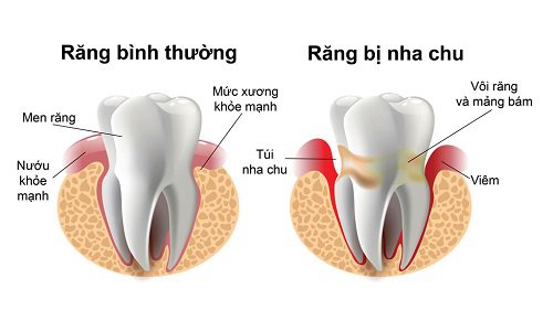 Bệnh viêm nha chu