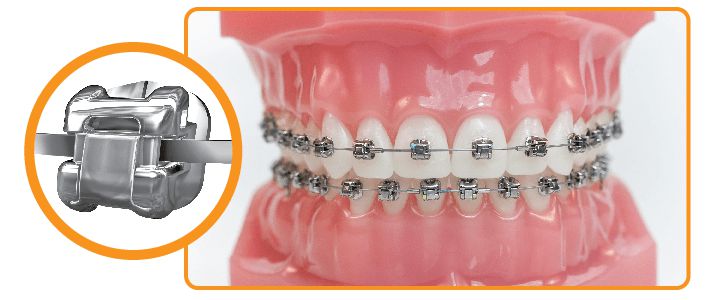 mắc cài kim loại tự buộc