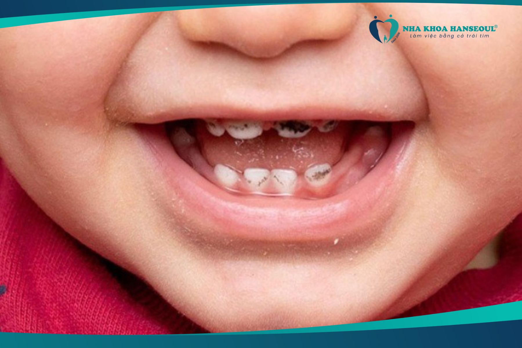 Vấn đề mắc sâu răng ở trẻ 