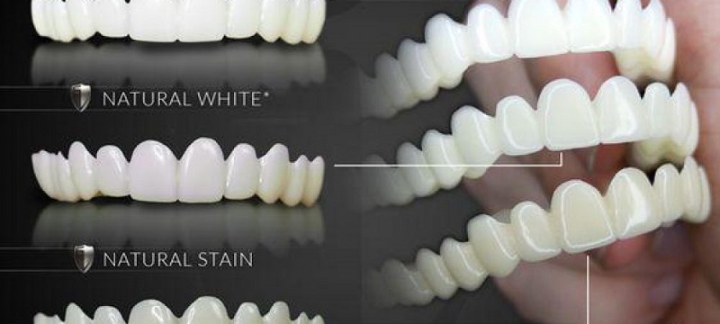 Chọn phom răng sứ thẩm mỹ