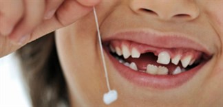 tự nhổ răng sữa tại nhà
