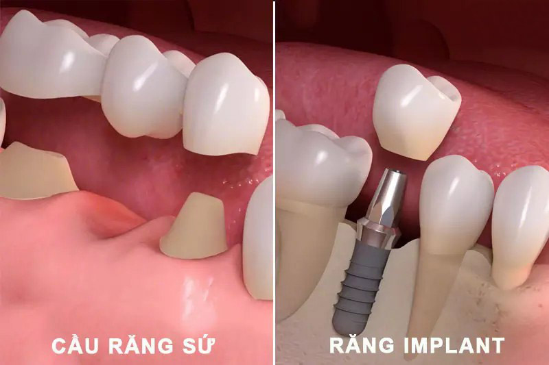 Cầu răng sứ và trồng răng implant