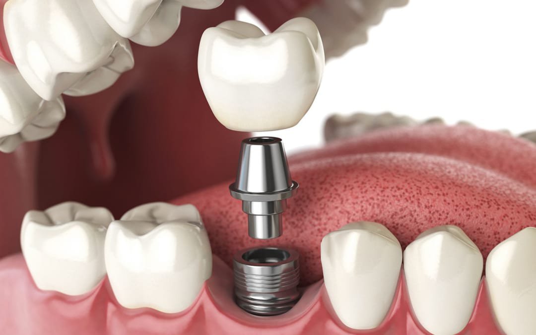 trong-rang-implant Cấy ghép Implant