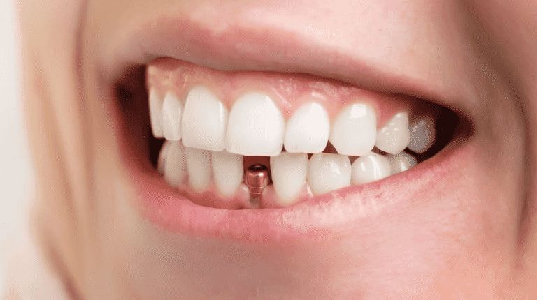 trong-rang-Implant trồng răng implant có đau không