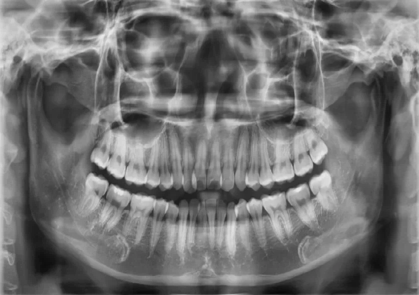 chup-ct-conbeam