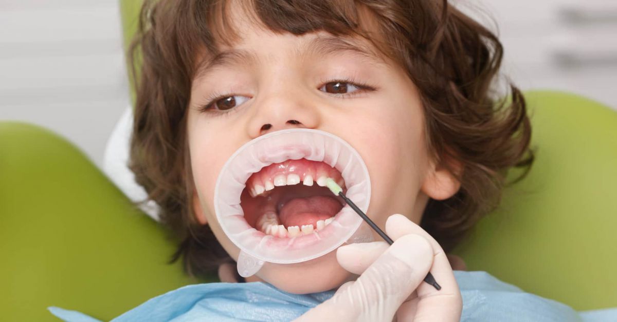 dieu-tri-bang-vecni-fluor Điều trị sâu răng bằng Vecni Fluor