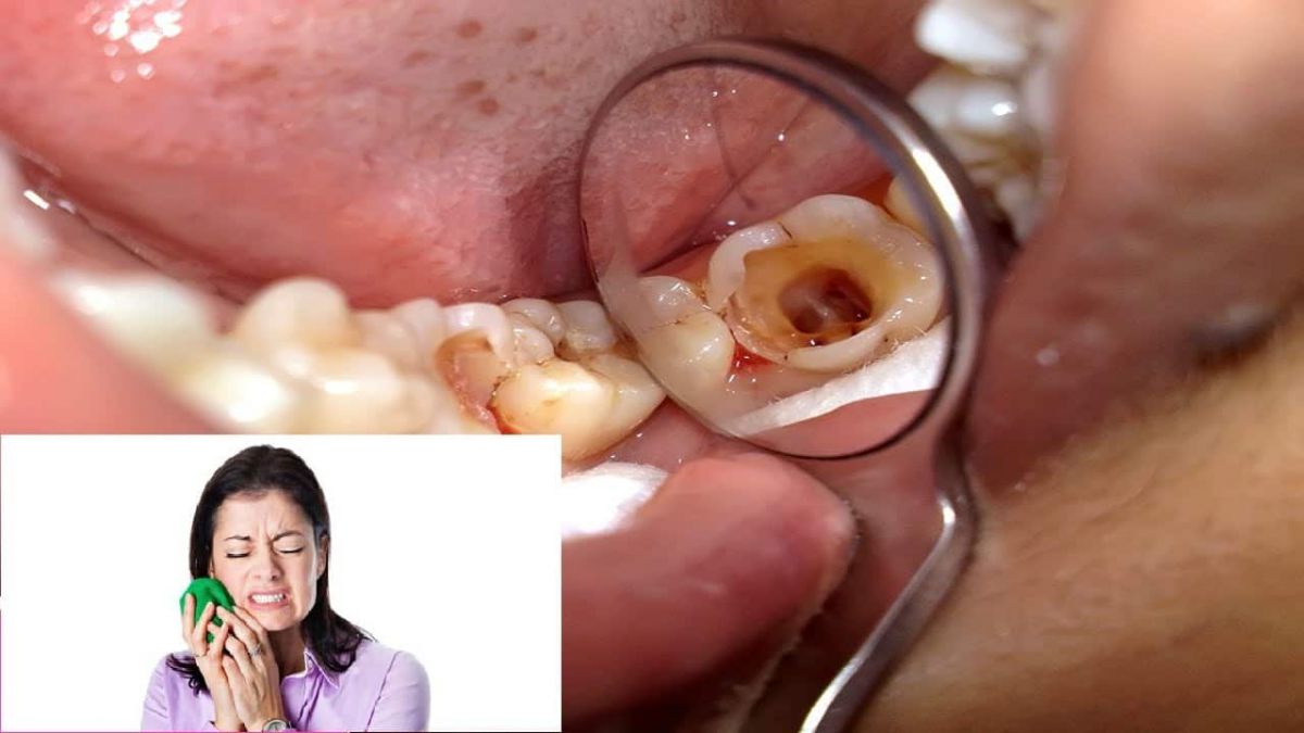 Điều trị tủy răng phải làm sao