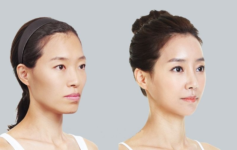 Hình ảnh niềng răng bị hóp
