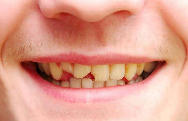 Trường hợp răng cửa bị sứt mẻ