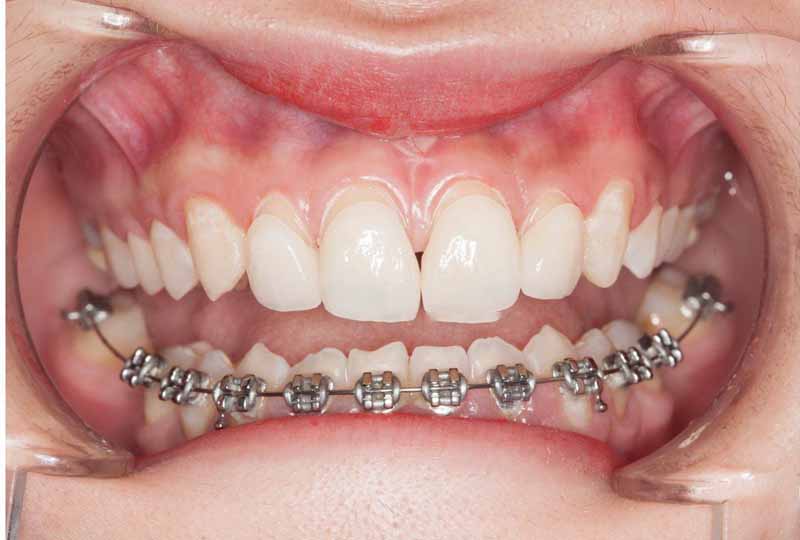 Hình ảnh niềng răng 1 hàm