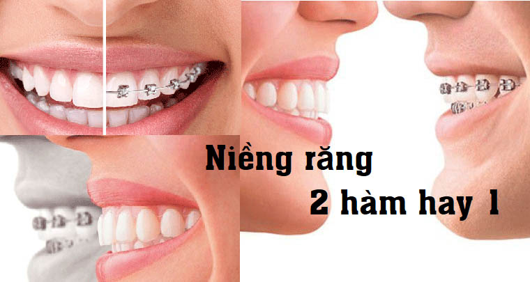 Niềng răng 1 hàm so với 2 hàm