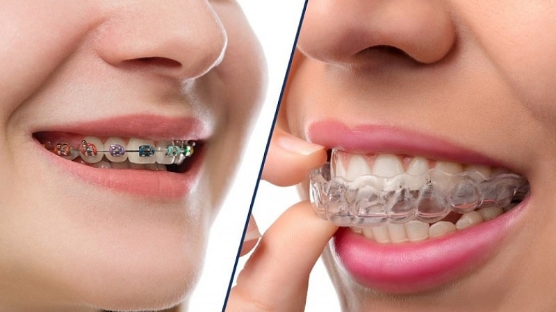 Niềng răng kim loại và niềng răng invisalign 1 hàm 