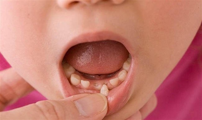 nhổ răng sữa sớm