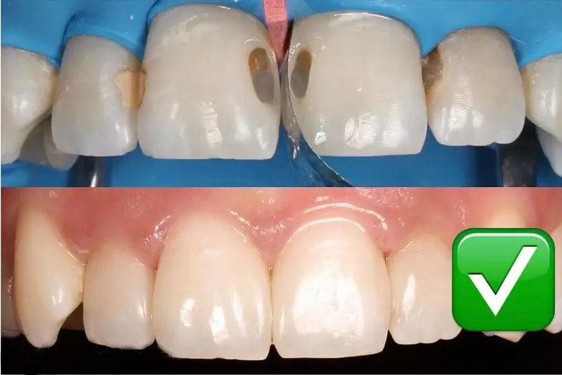 Trám răng cửa thẩm mỹ