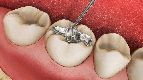 vật liệu trám răng Amalgam