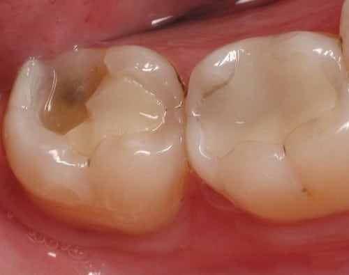 Vật liệu trám Composite