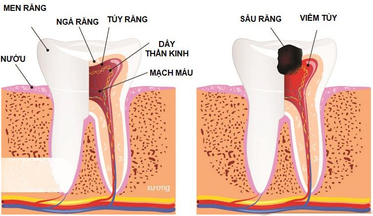 Bệnh viêm tủy răng