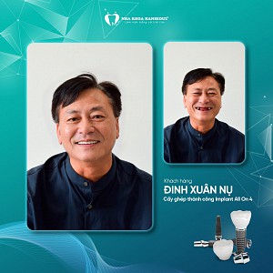 Khách hàng Đinh Xuân Nụ cấy implant All on 4