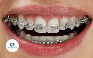 Địa chỉ niềng răng uy tín tại Hoài Đức