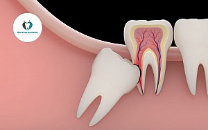 Nhổ răng khôn an toàn, không đau tại Hoài Đức, Hà Nội