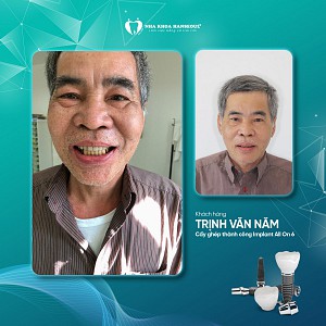 Khách hàng Trịnh Văn Năm cấy ghép implant All on 6