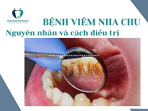 Bệnh viêm nha chu nguyên nhân và phương pháp điều trị