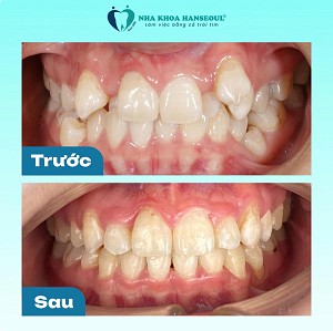 3 phương pháp niềng răng cho trẻ em, và chi phí niềng răng cho trẻ