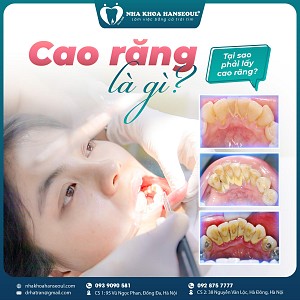 Niềng răng có đau ko? Sự thật đằng sau 3 giai đoạn “ám ảnh” nhất