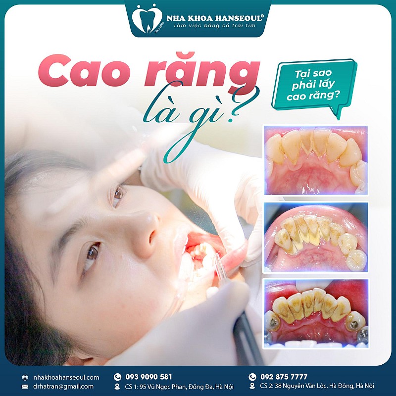Lấy cao răng xong bị ê buốt: Đừng chủ quan, có thể nướu bạn đang “kêu cứu”